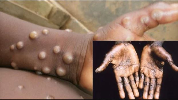 Suspected Monkeypox Cases Rise To 141 In 13 States